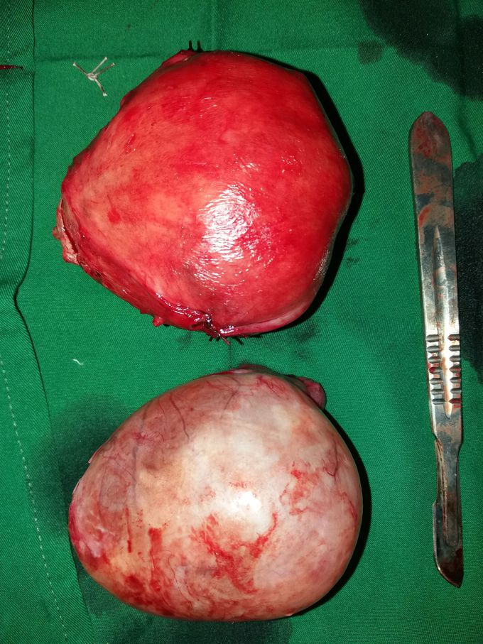 Tumor