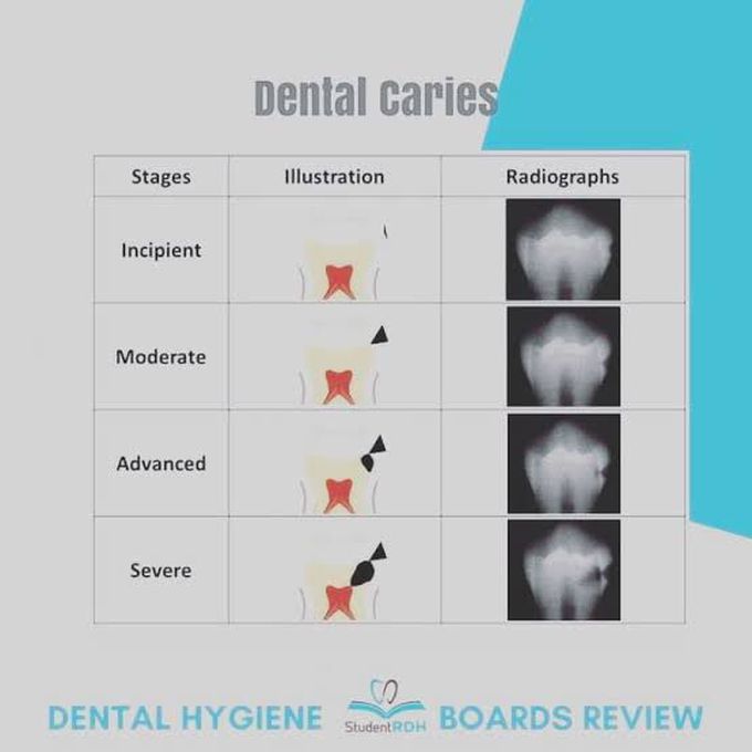 Caries classification according to severity