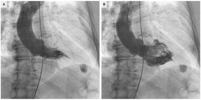 Apical Hypertrophic Cardiomyopathy