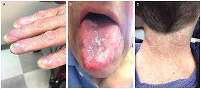 Causes of dyskeratosis congenita