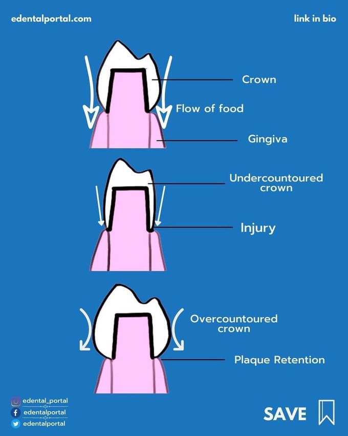 The ideal shape of the crown