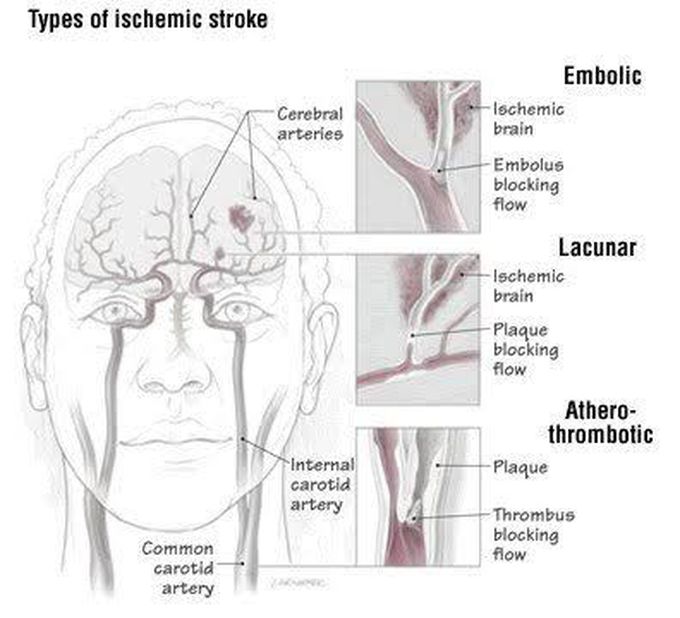These are the types of ischemic stroke