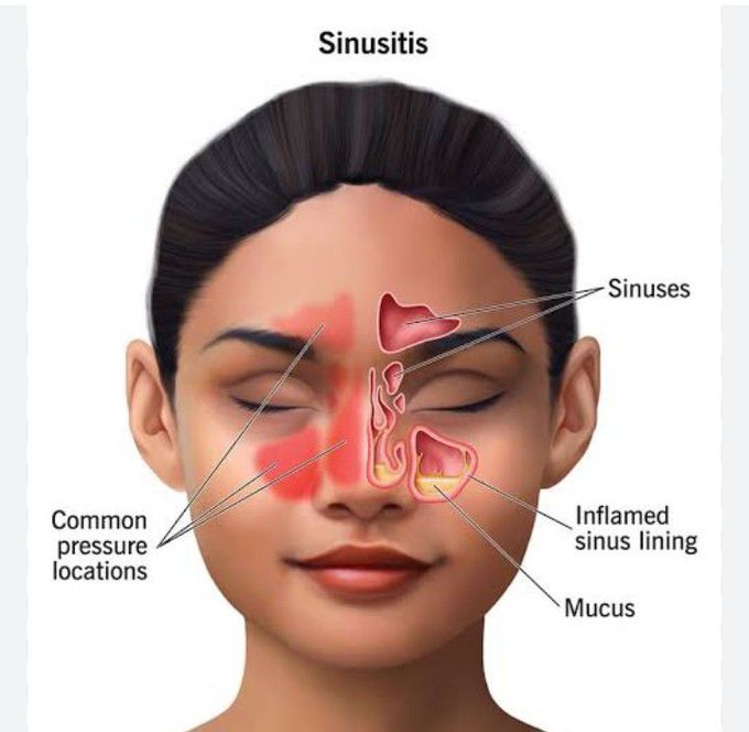 Sinuses