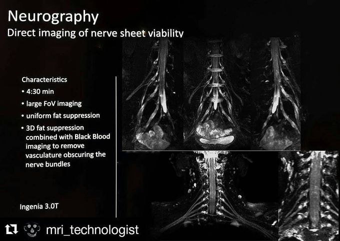 3D Volumetric Nerve-Sheath Weighted RARE Imaging