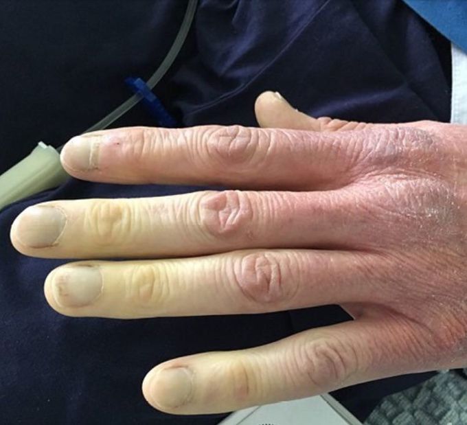 A 40-year-old male presents to the emergency department with sharp chest pain and palpitations. He says the pain is worse when he lies down and is exacerbated by coughing, but improves when he moves to a seated position. He was recently diagnosed with systemic lupus erythematosus (SLE) after investigation for recurrent cyanotic discoloration and numbness of his fingers following exposure to the cold, as well as small-joint polyarticular arthritis.