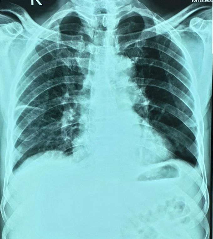 A 65 year old man with fever