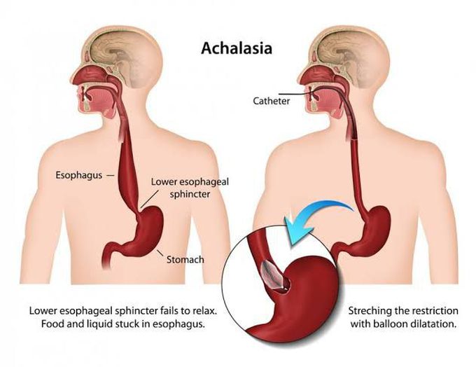 Achalasia