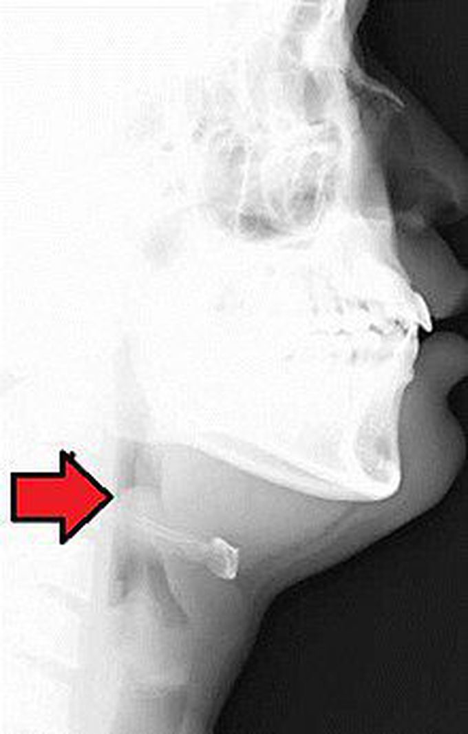 signs and symptoms of epiglottitis