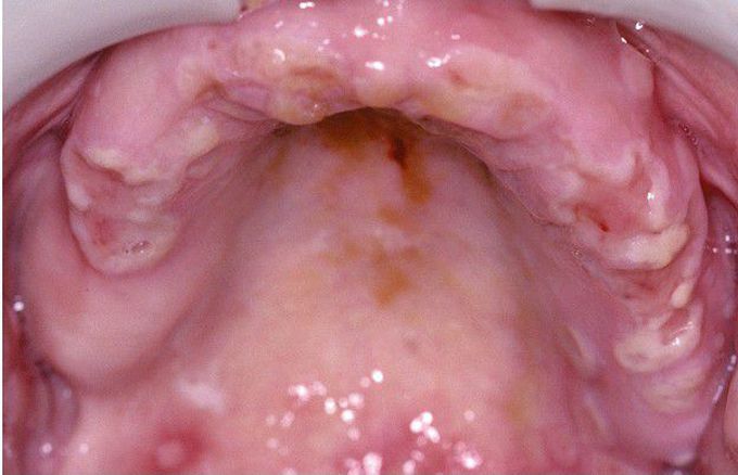 Chronic Herpetic Infection