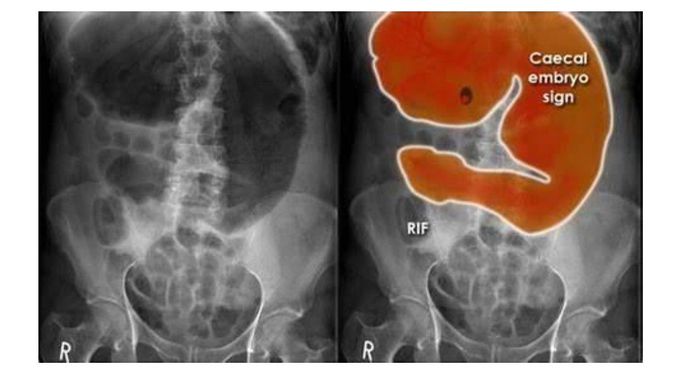 Cecal Empryo sign in Cecal volvulus
