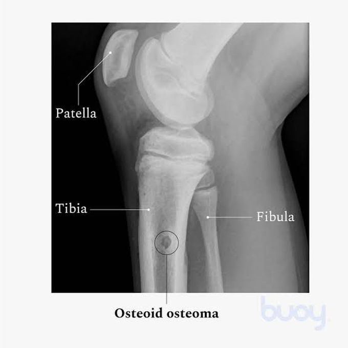 Causes of osteoid osteoma