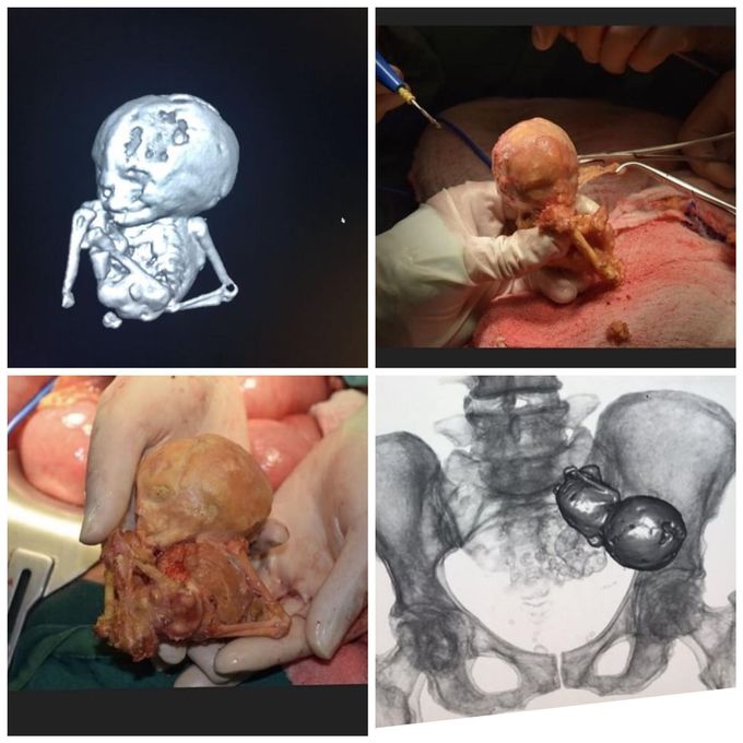 An AMAZING case of a lithopedion (stone baby) that was inside his mother’s pelvis for 40 years !!
.