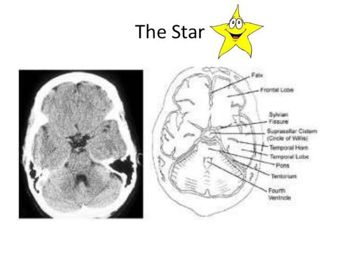 Star sign in subarachnoid hemorrhage