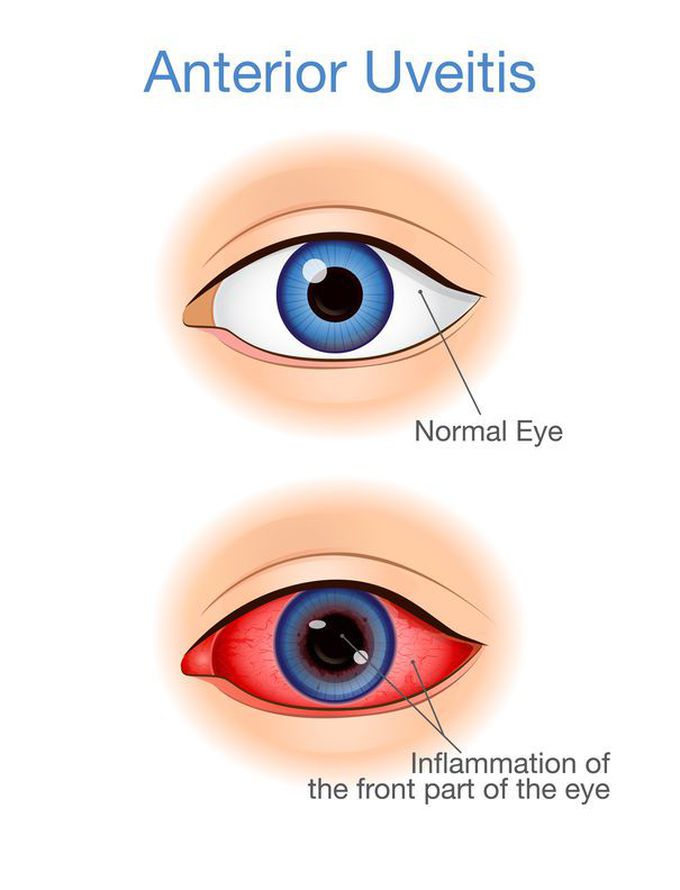 Uveitis