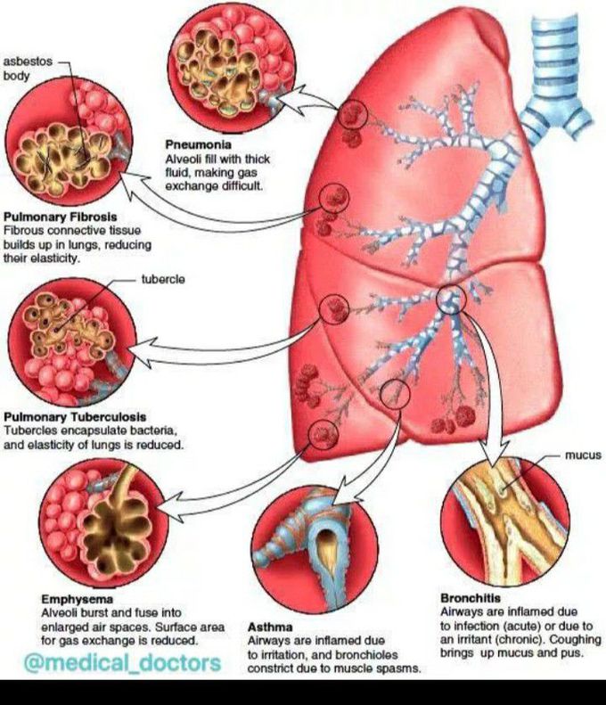 Disease of the lungs