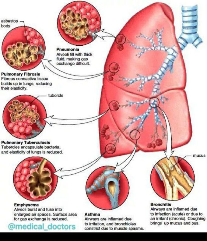 Disease of the lungs - MEDizzy