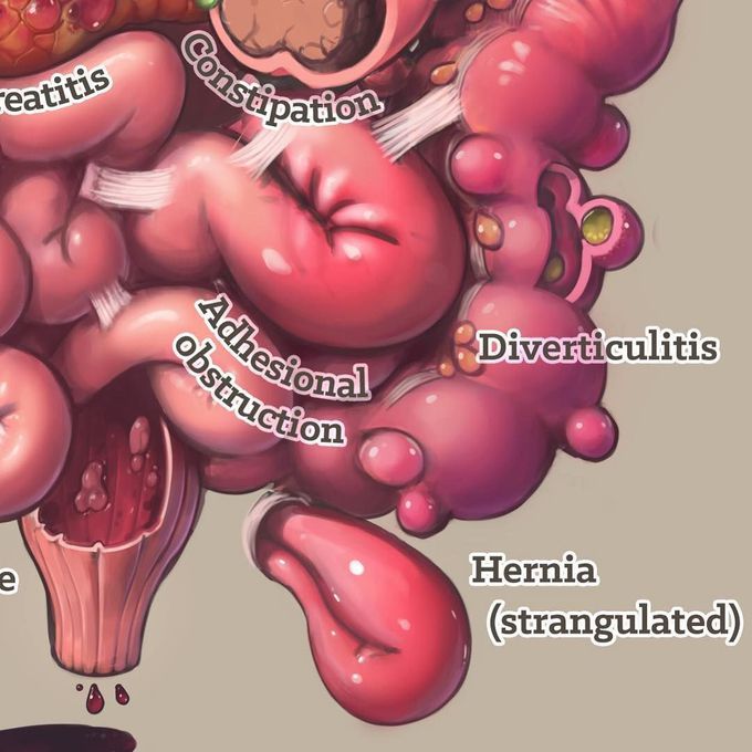 Cause of abdominal pain.
