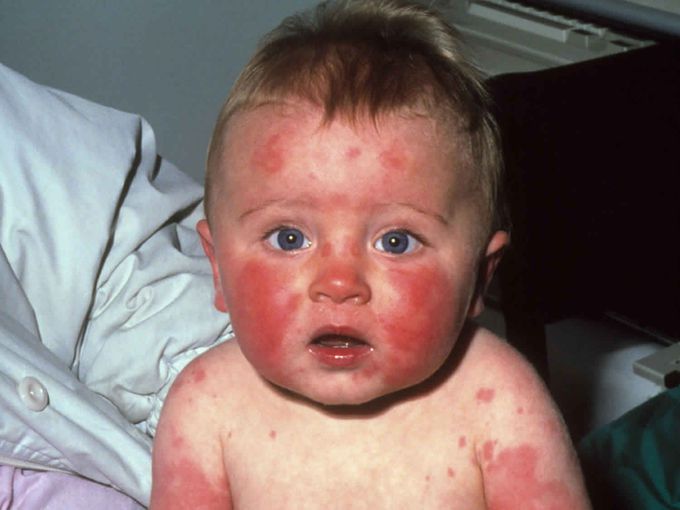 Erythema infectiosum is cause by