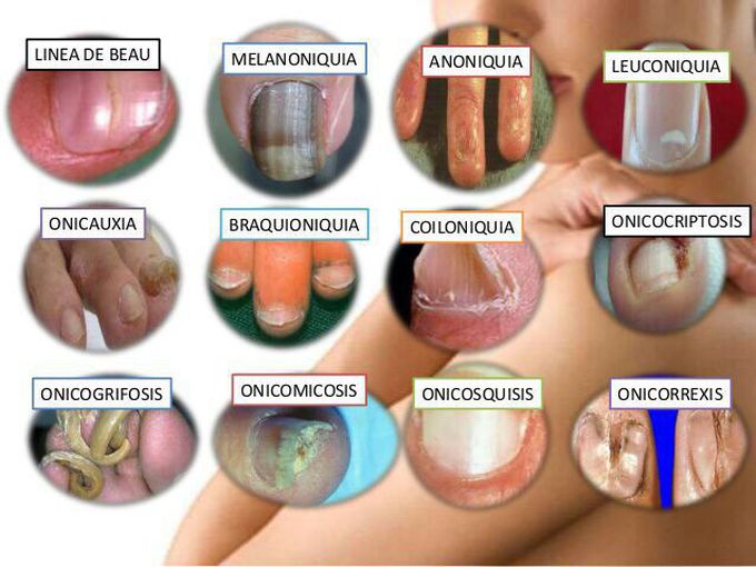 Nails lesions