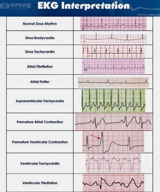 EKG INTERPRETATION