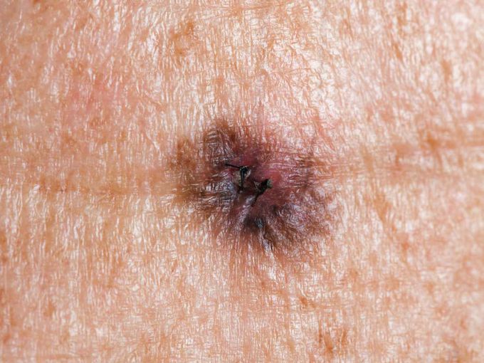 Deadly skin cancer could be halted with arthritis drug