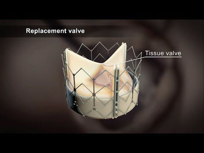 Transcatheter Aortic Valve Implantation-
Animation