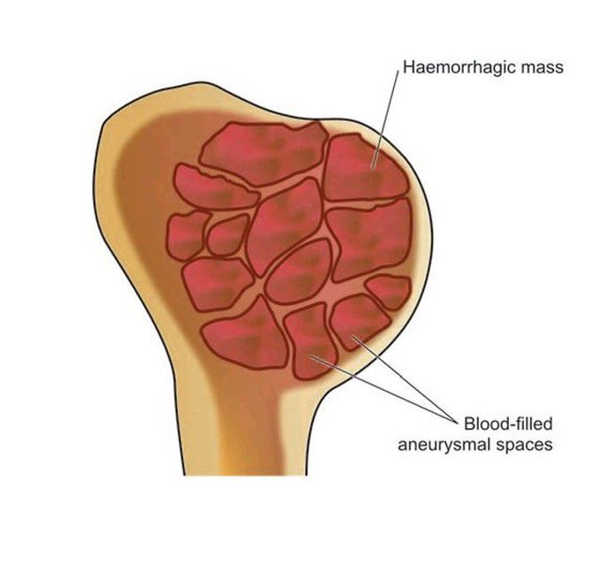 Aneurysmal bone cyst