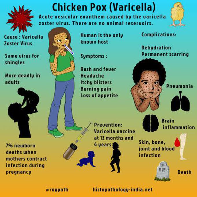 Chicken Pox