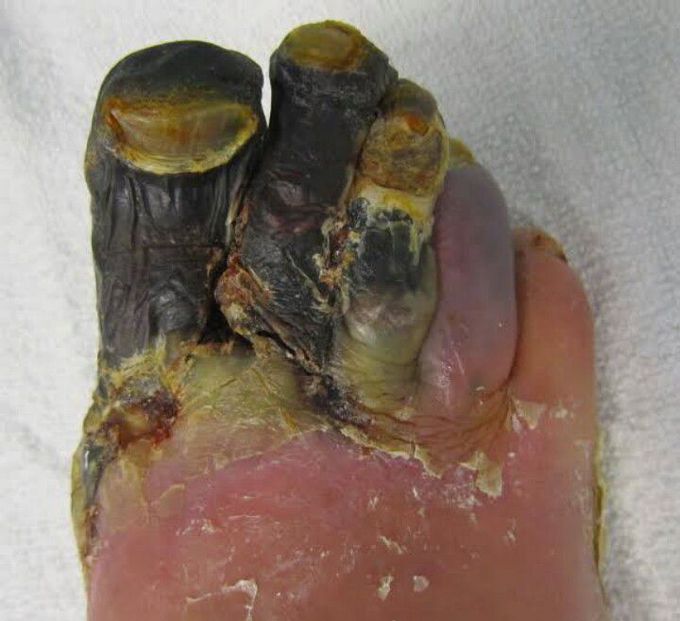 Gangrene Foot