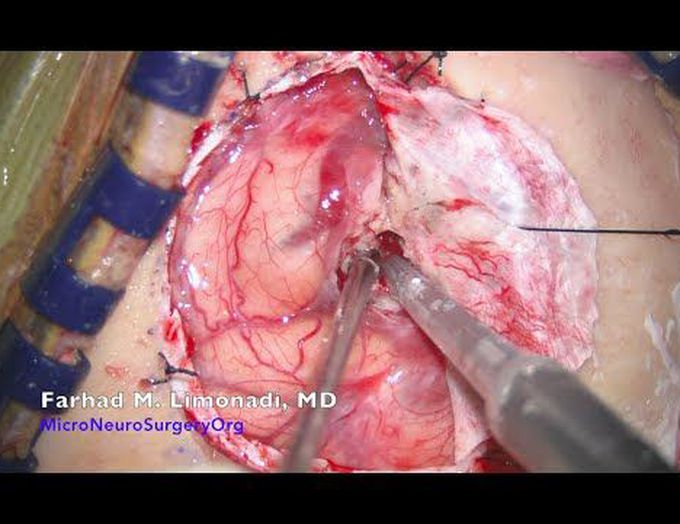Brain Surgery: A patient with brain tumor and paralyzed undergoes brain surgery