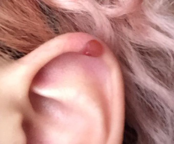 Hyperkeratotic Actinic Keratosis