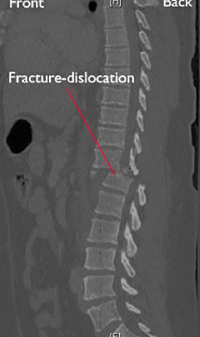 Fracture-dislocation in vertebrae
