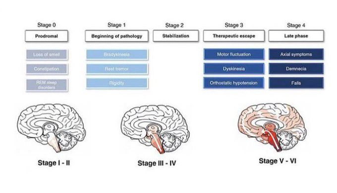 Stages of Parkinson's disease