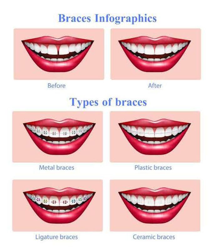 Types of braces