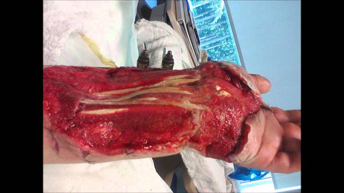 Auto Accident "Degloves" Arm