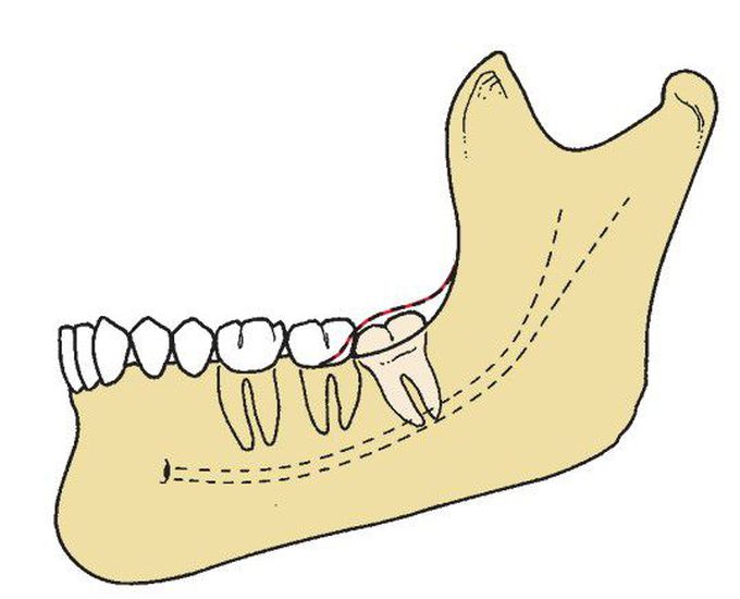 Soft tissue impaction