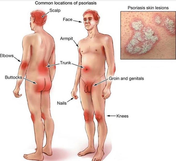 psoriasis