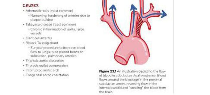 These are the causes of Subclavian Steal syndrome