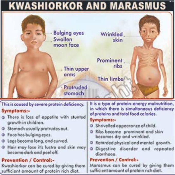 Kwashiorkor and Marasmus