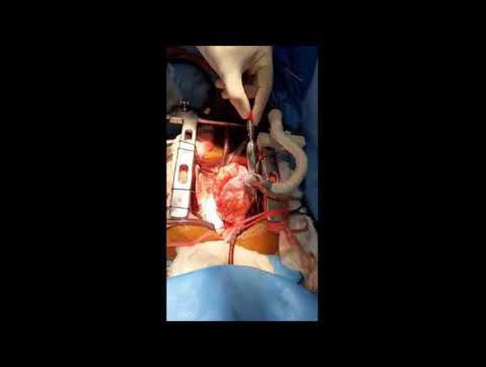 Use of Heart Positioning Device During Extracardiac Fontan Procedure