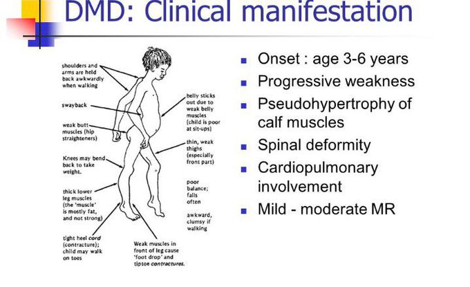 Duchenne Muscular Dystrophy.