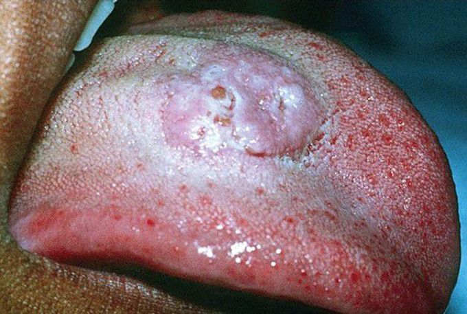 Coccidioidomycosis