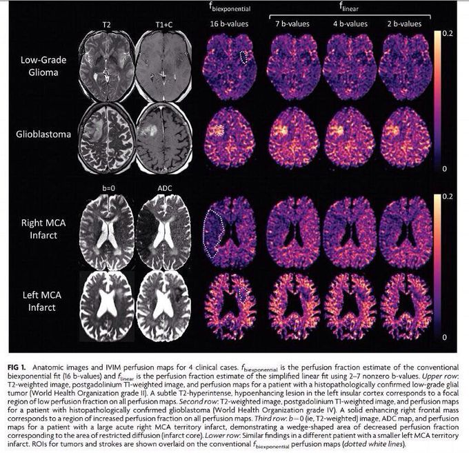 A Simplified Model for Intravoxel Incoherent Motion Perfusion Imaging of the Brain&nbsp;