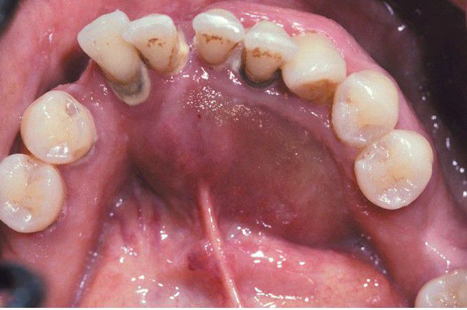 Ameloblastoma