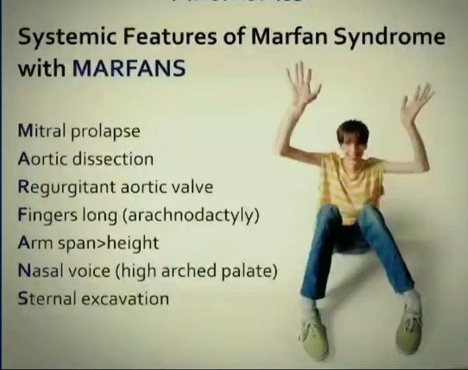 Mnemonics to learn systemic features of Marfan syndrome