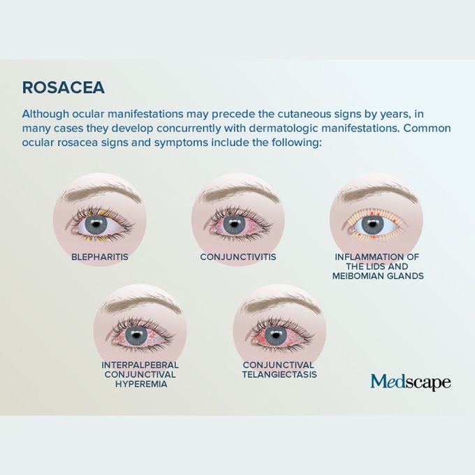 Ocular Rosacea