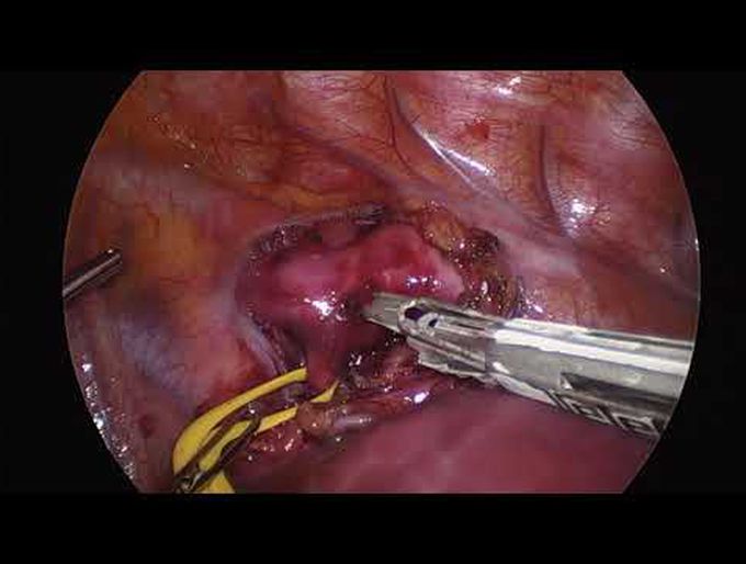 Thoracoscopic Repair of a Double Aortic Arch