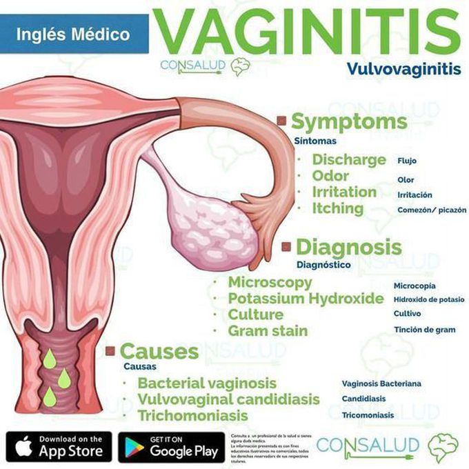 Vaginits