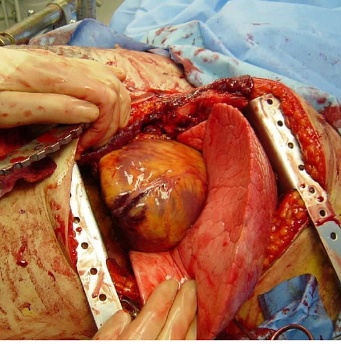 Thoracotomy