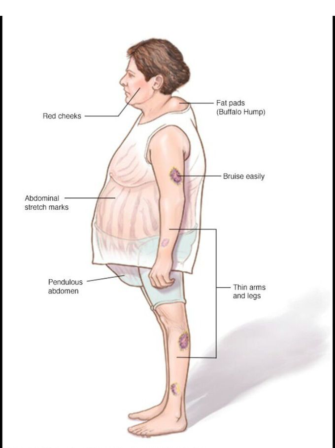 Cushing Syndrome MEDizzy